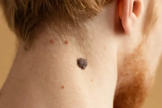 close-up-young-man-with-mole-neck