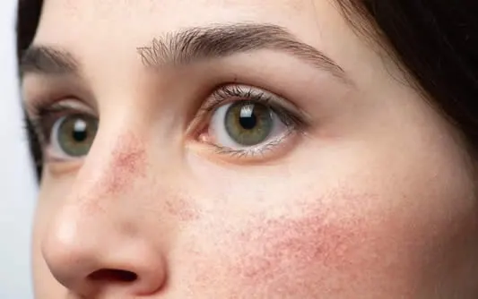 rosacea on cheeks face